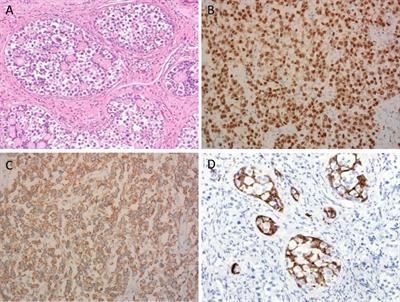 Ovarian gonadoblastoma with dysgerminoma in a girl with 46,XX karyotype 17a-hydroxylase/17, 20-lyase deficiency: A case report and literature review